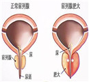 附睾炎给男性带来了哪些危害呢